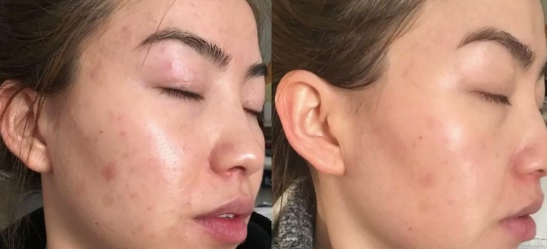 Before &After